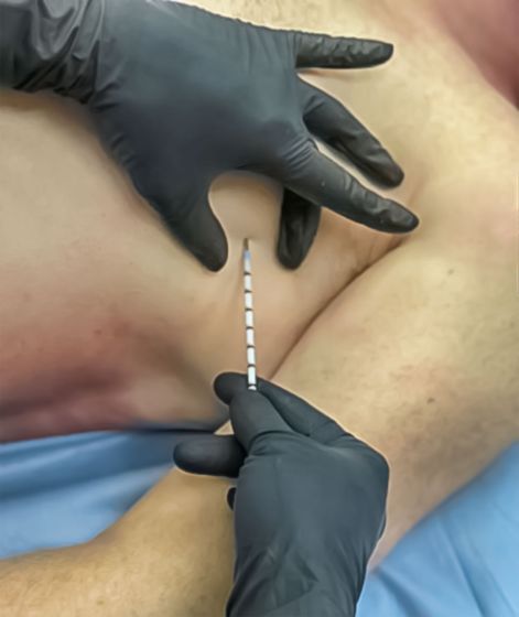 SPEAR - Simplified Pneumothorax Emergency Air Release - Praetorian Consulting Store