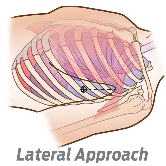 SPEAR - Simplified Pneumothorax Emergency Air Release - Praetorian Consulting Store